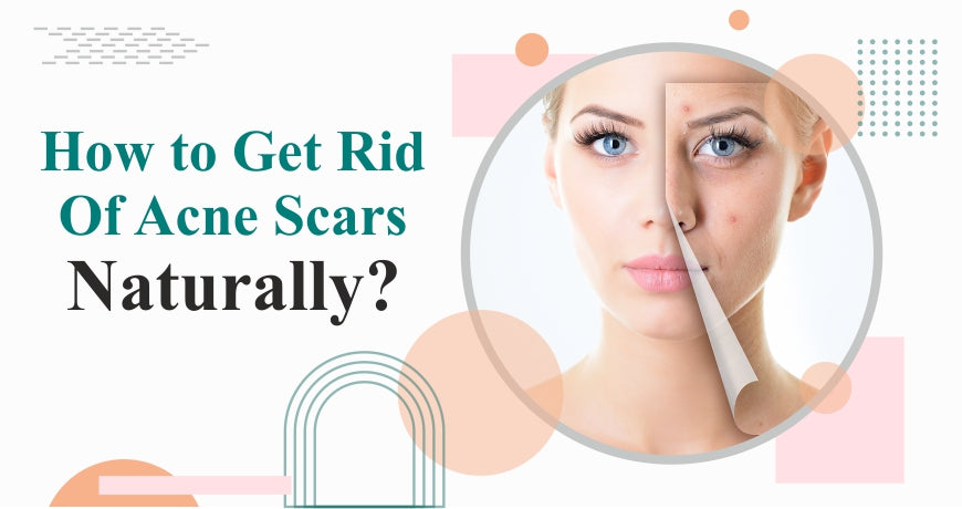 How to Get Rid of Acne Scars Naturally? How to Get Rid of Acne Scars Naturally?